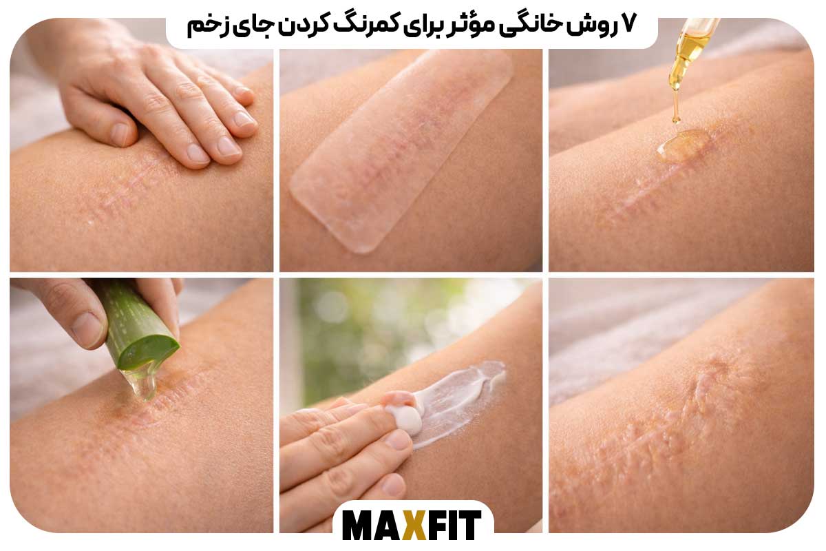 7 Effective Home Remedies to Lighten Scars
