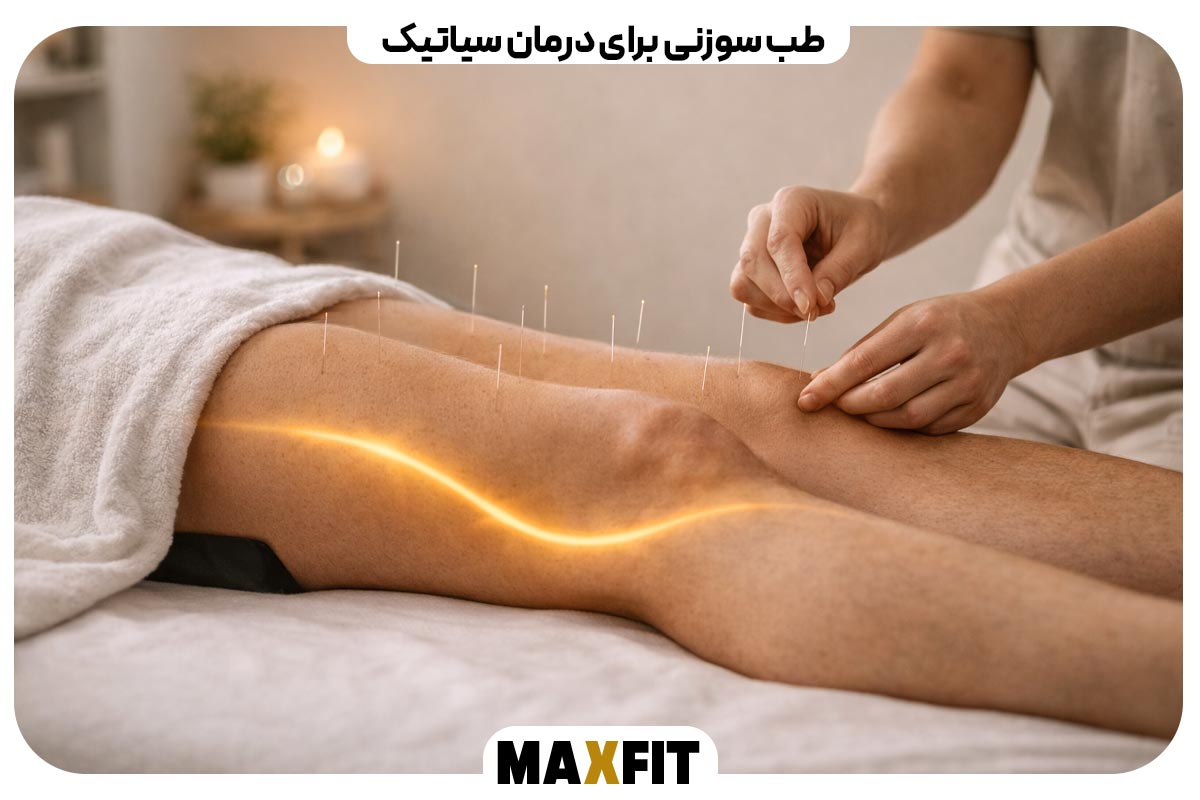 Acupuncture for sciatica treatment