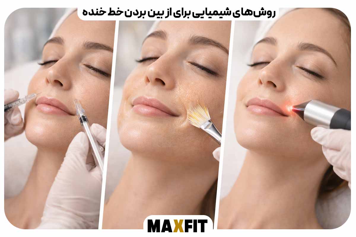 Chemical methods to remove laugh lines