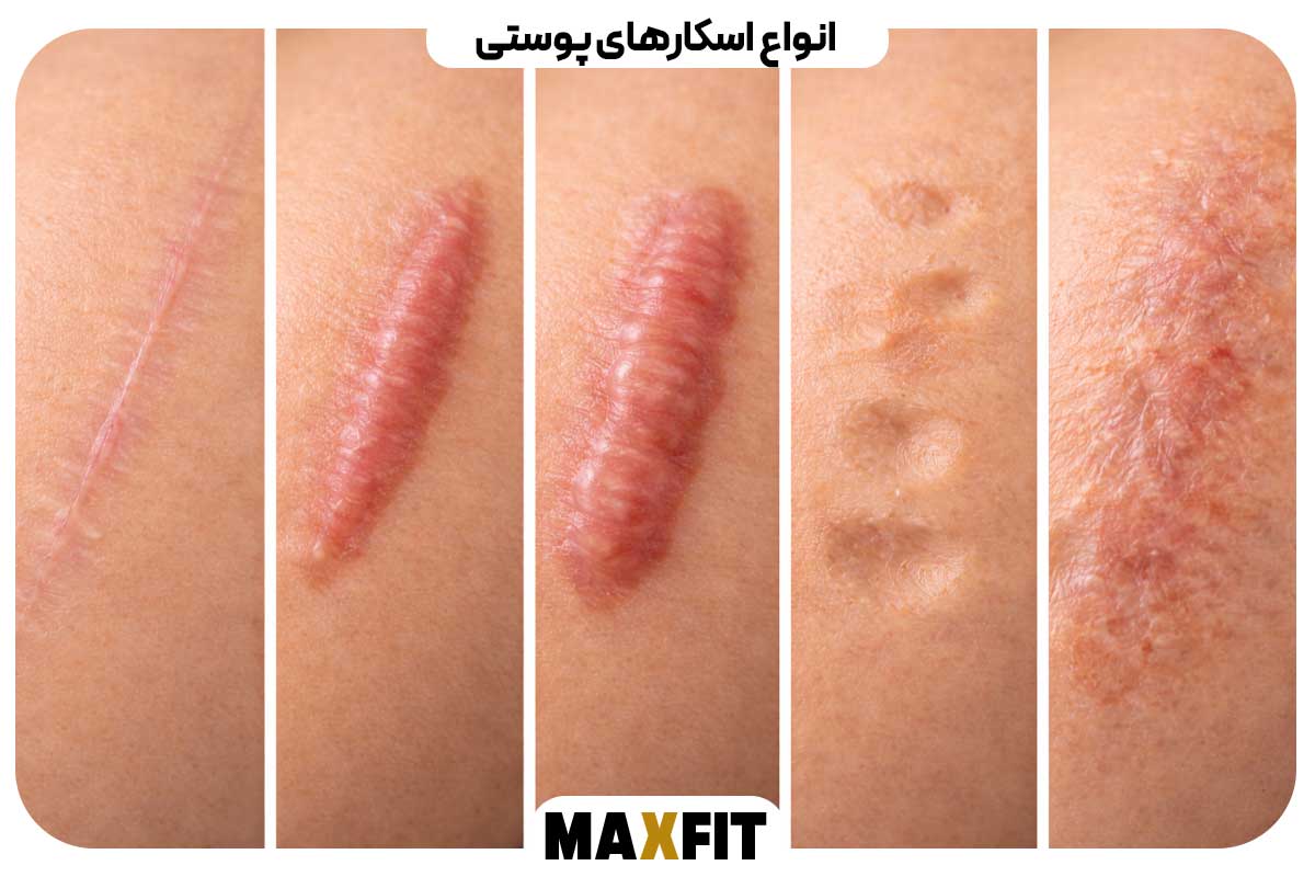 Types of skin scars