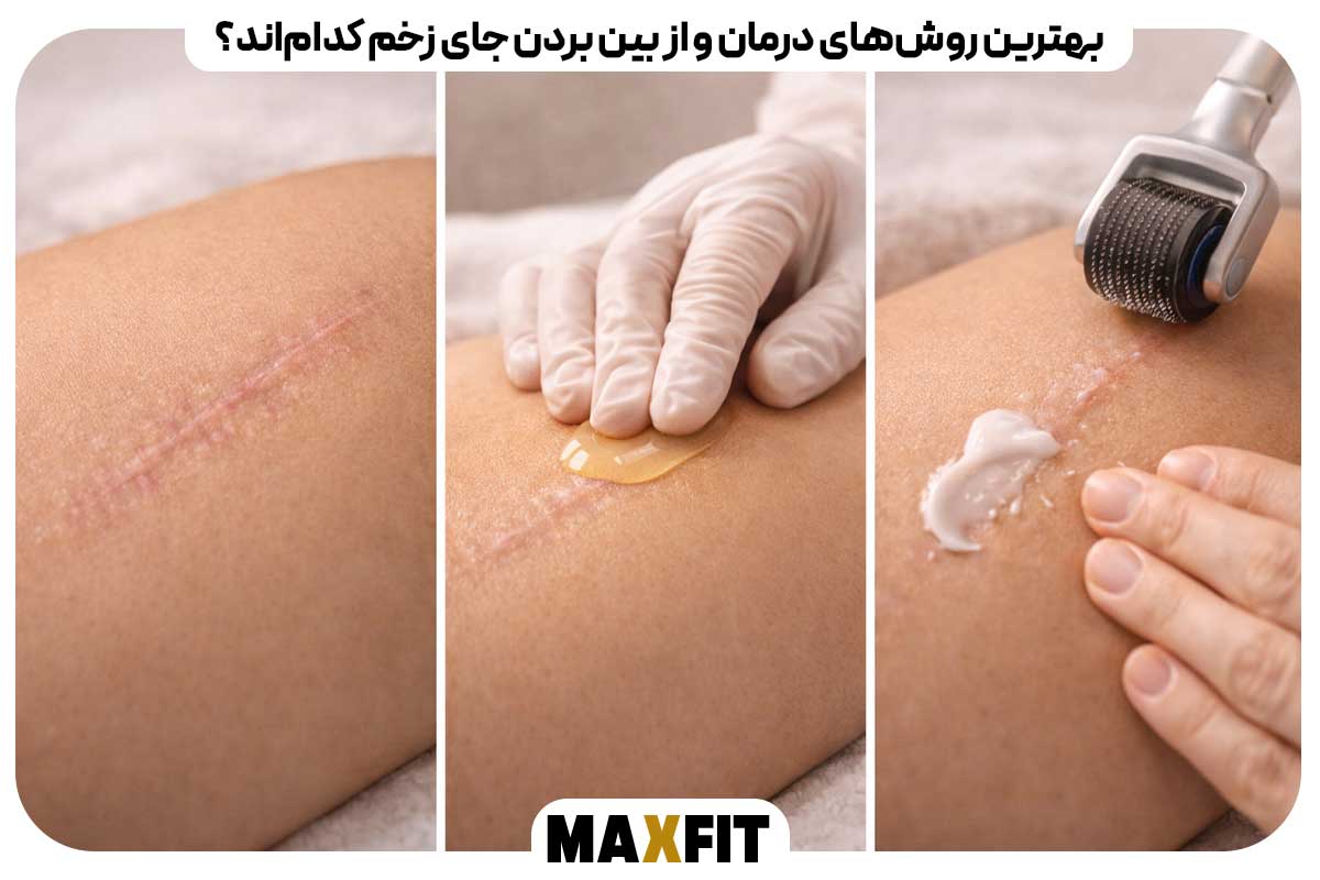 What are the best methods for treating and removing scars?