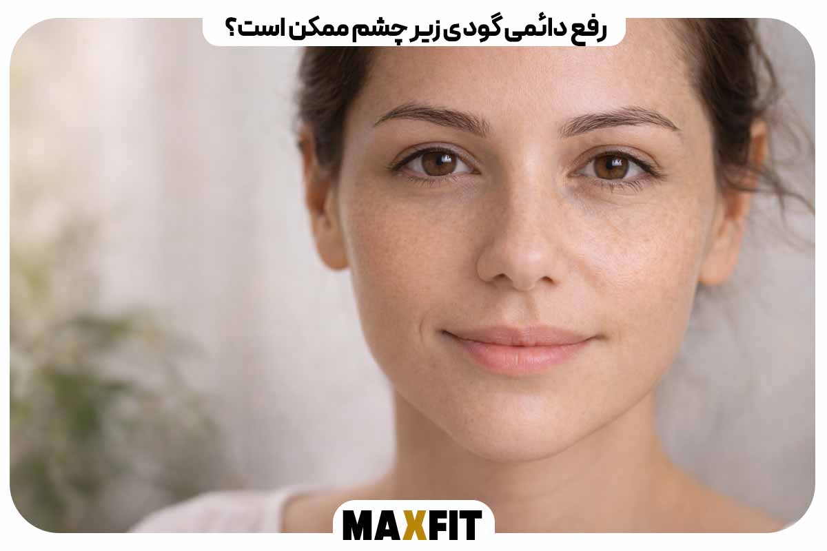 رفع دائمی گودی زیر چشم ممکن است؟