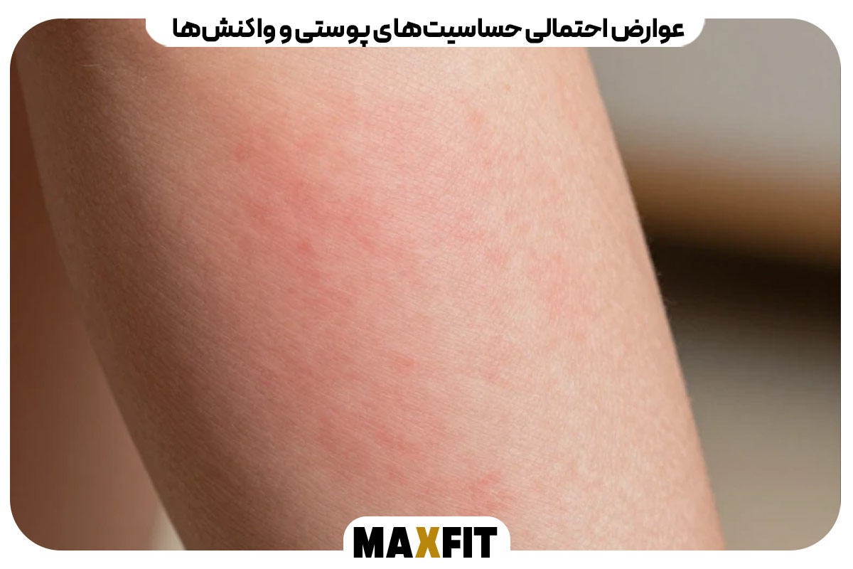 عوارض احتمالی حساسیت‌های پوستی و واکنش‌ها