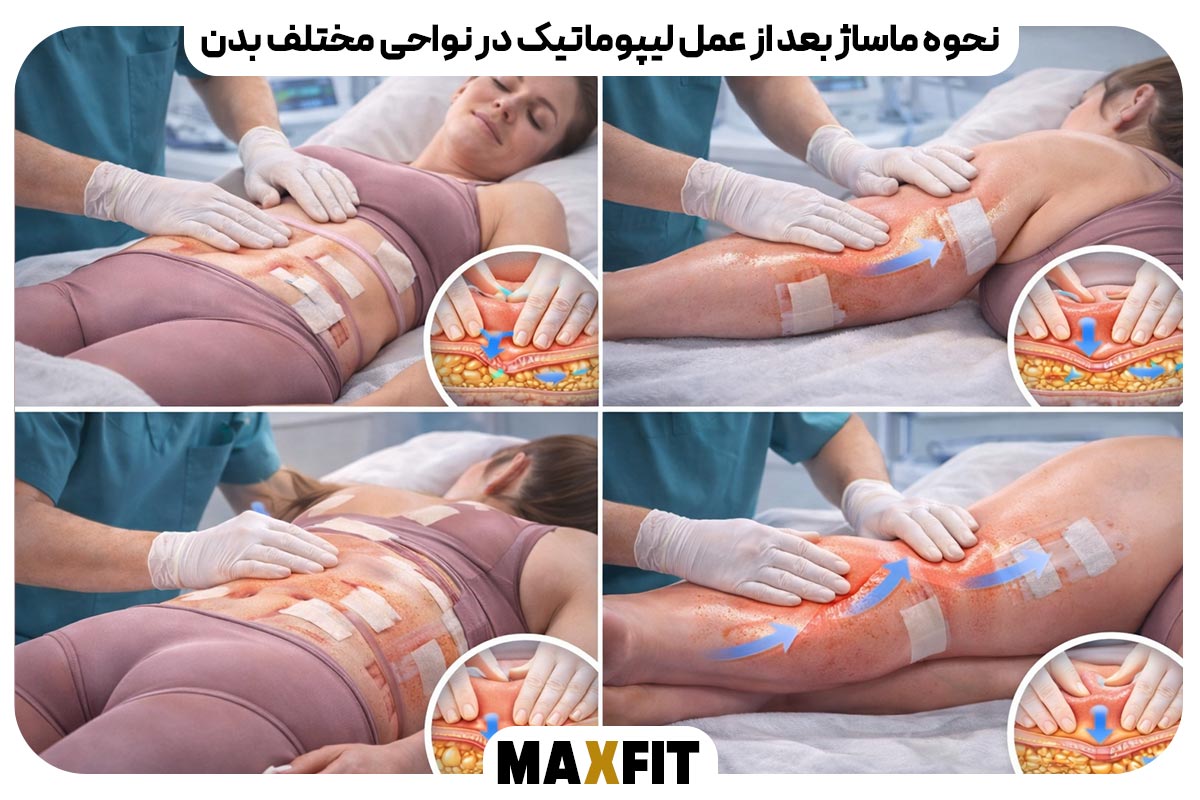 نحوه ماساژ بعد از عمل لیپوماتیک در نواحی مختلف بدن