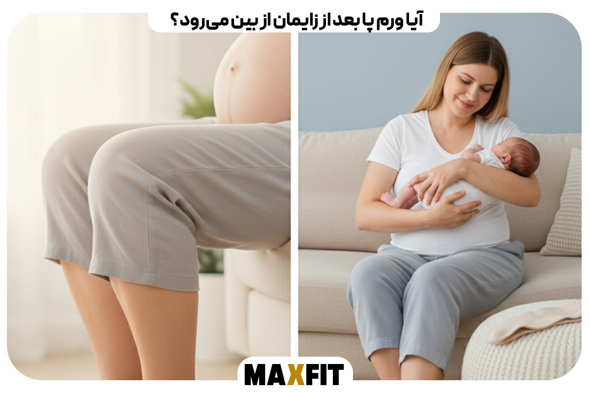 ورم پا در بارداری