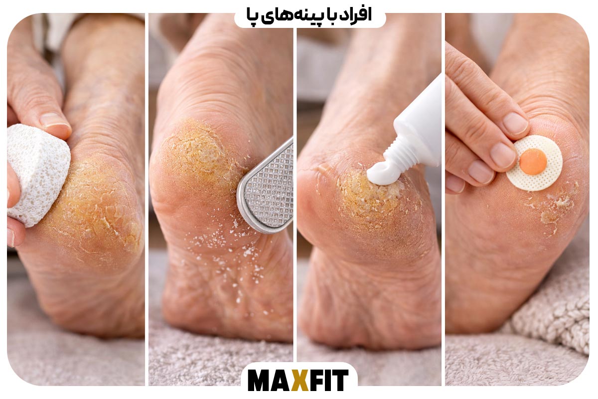 People with calluses