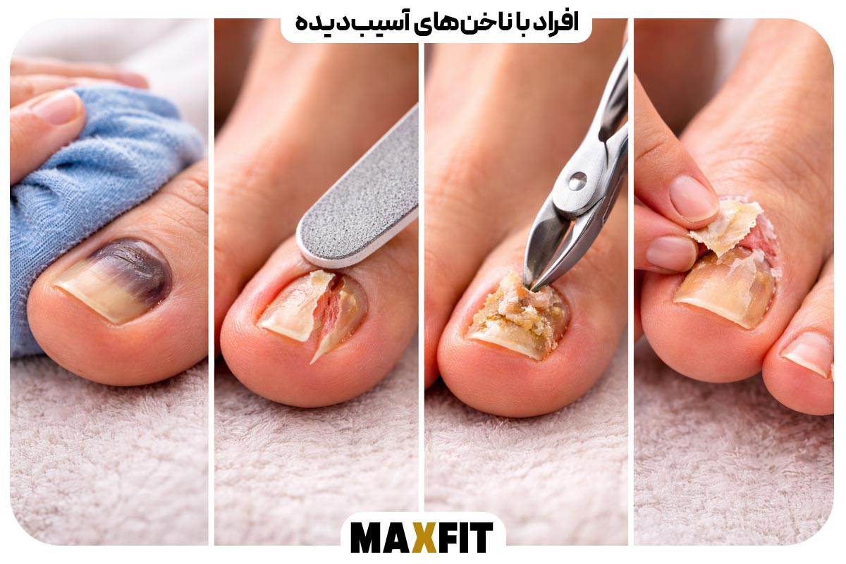 People with damaged nails