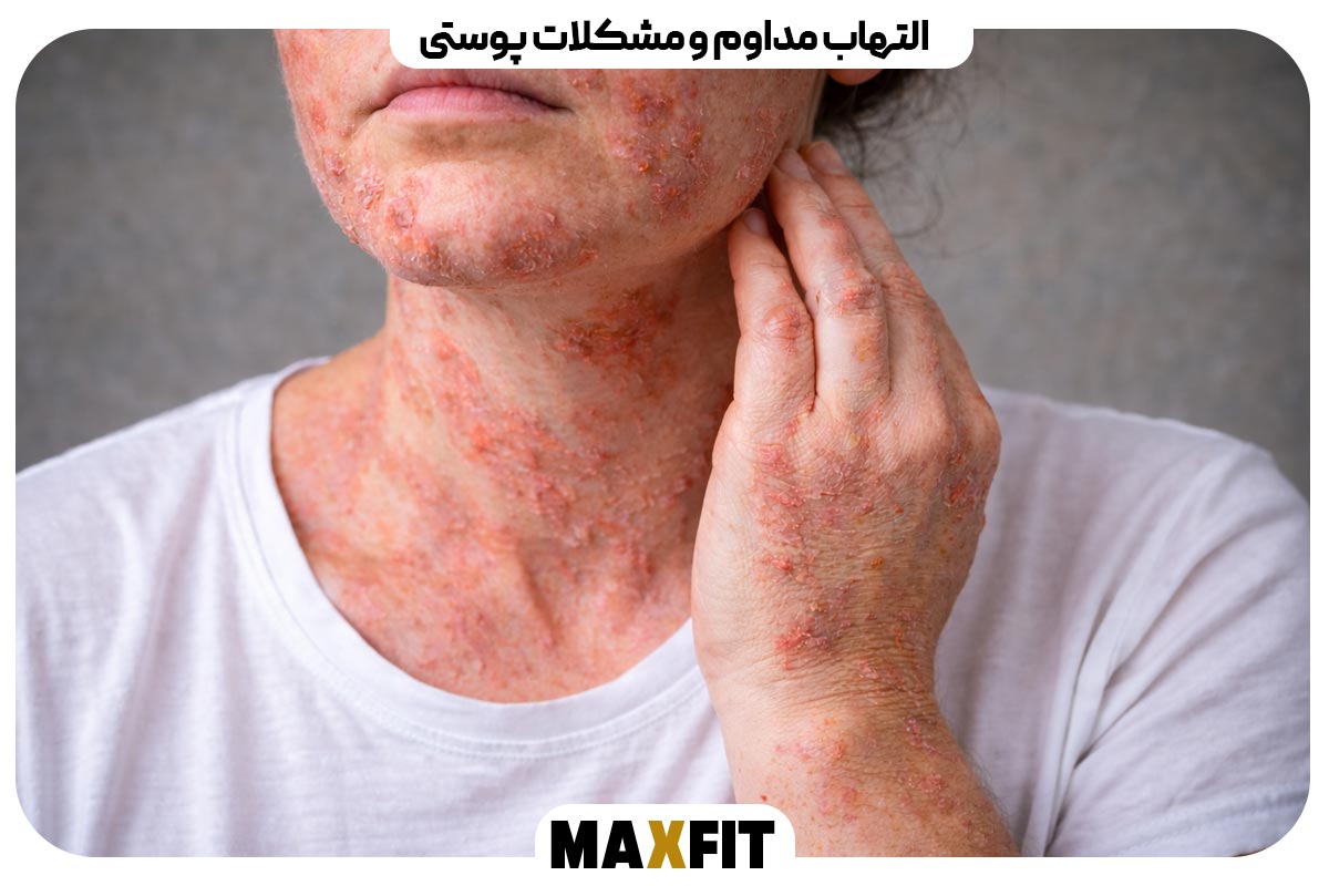 Persistent inflammation and skin problems