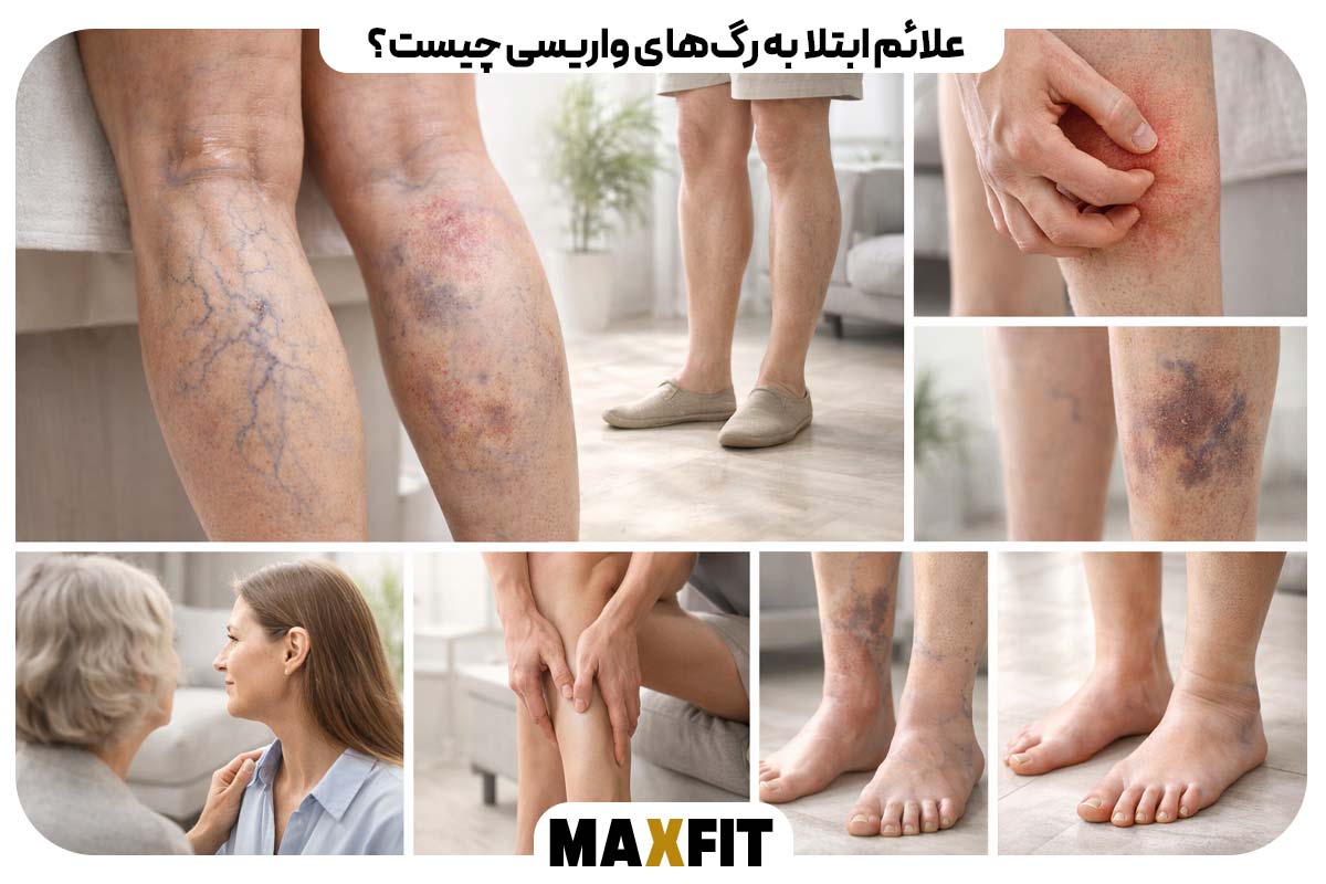 What are the symptoms of varicose veins?