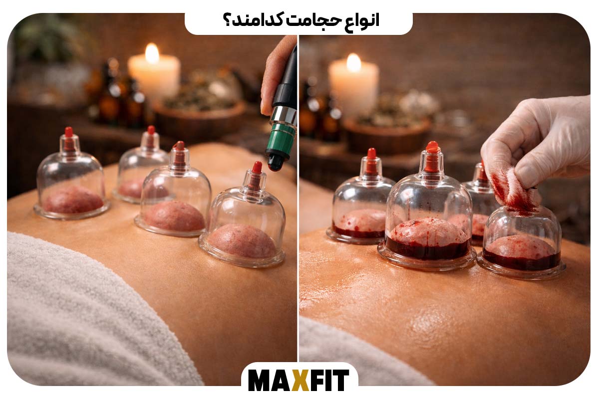 انواع حجامت کدامند؟