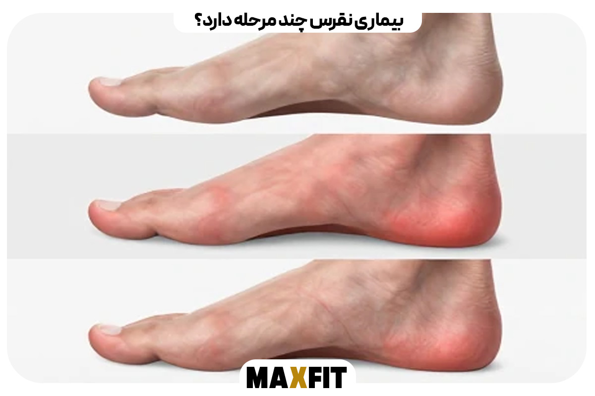 بیماری نقرس چند مرحله دارد؟