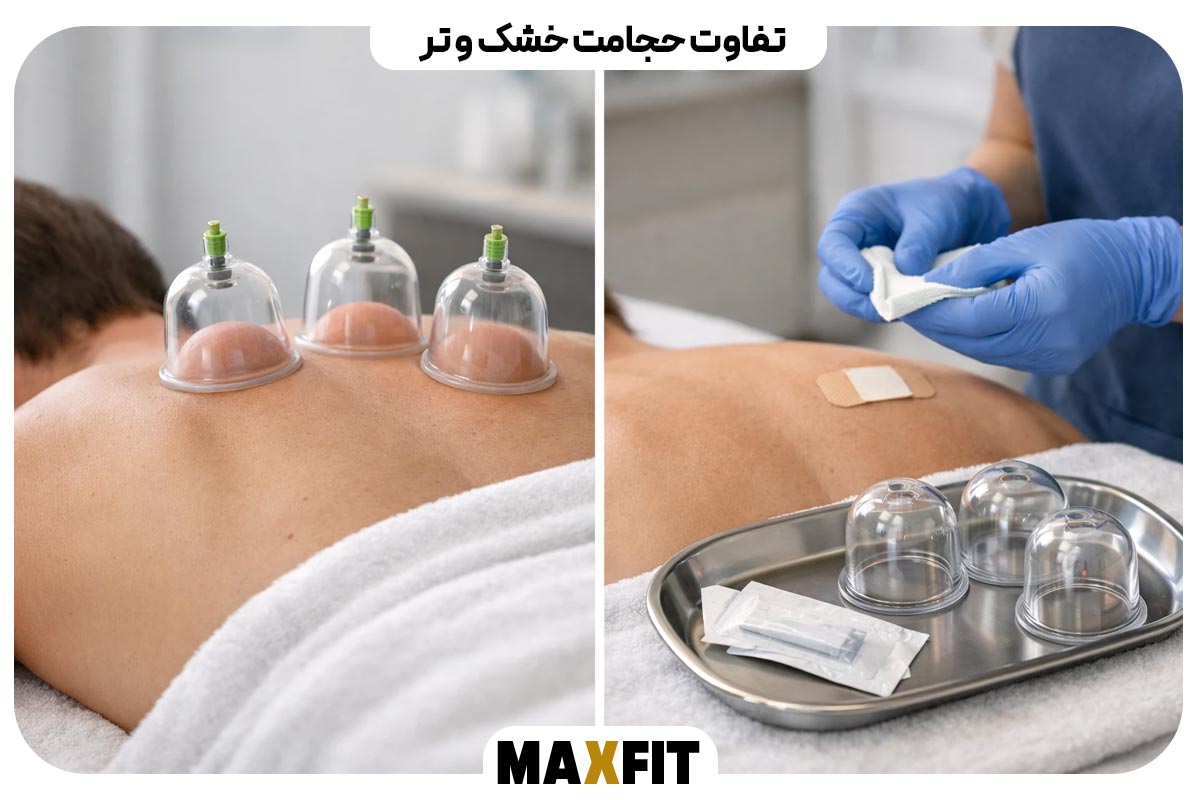 تفاوت حجامت خشک و تر