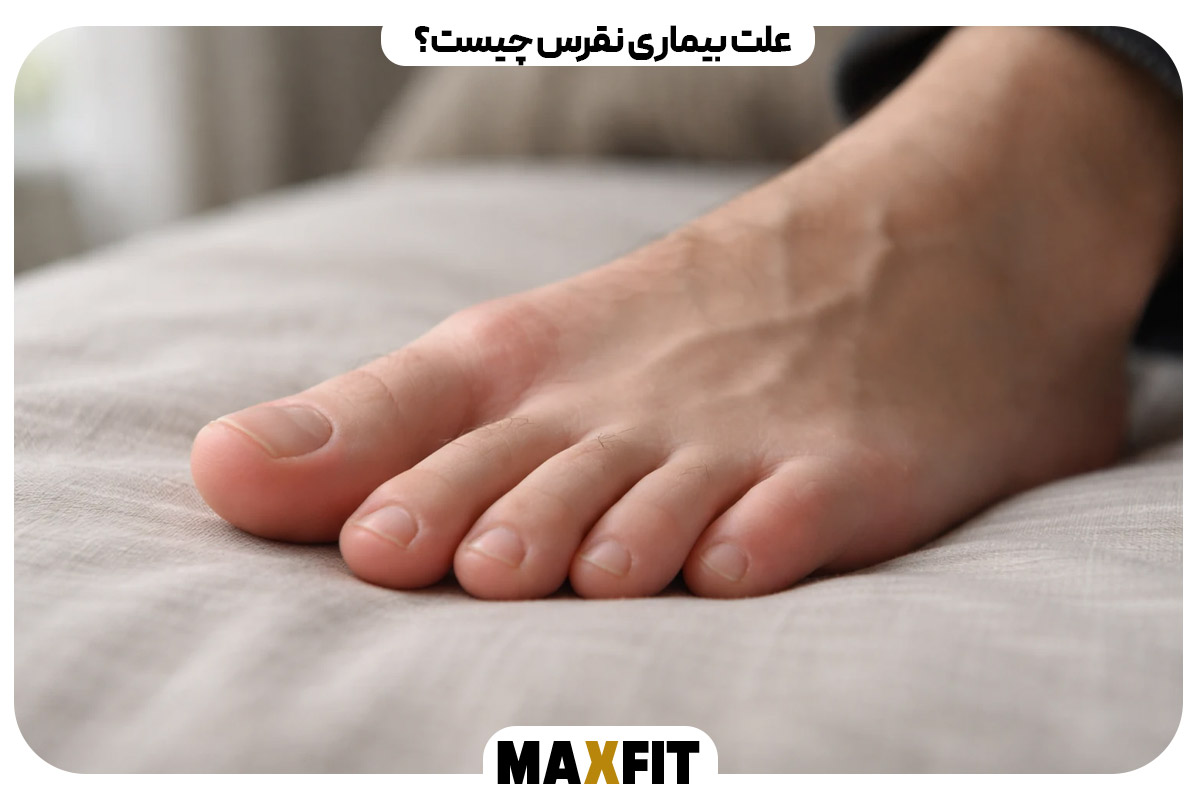 علت بیماری نقرس چیست