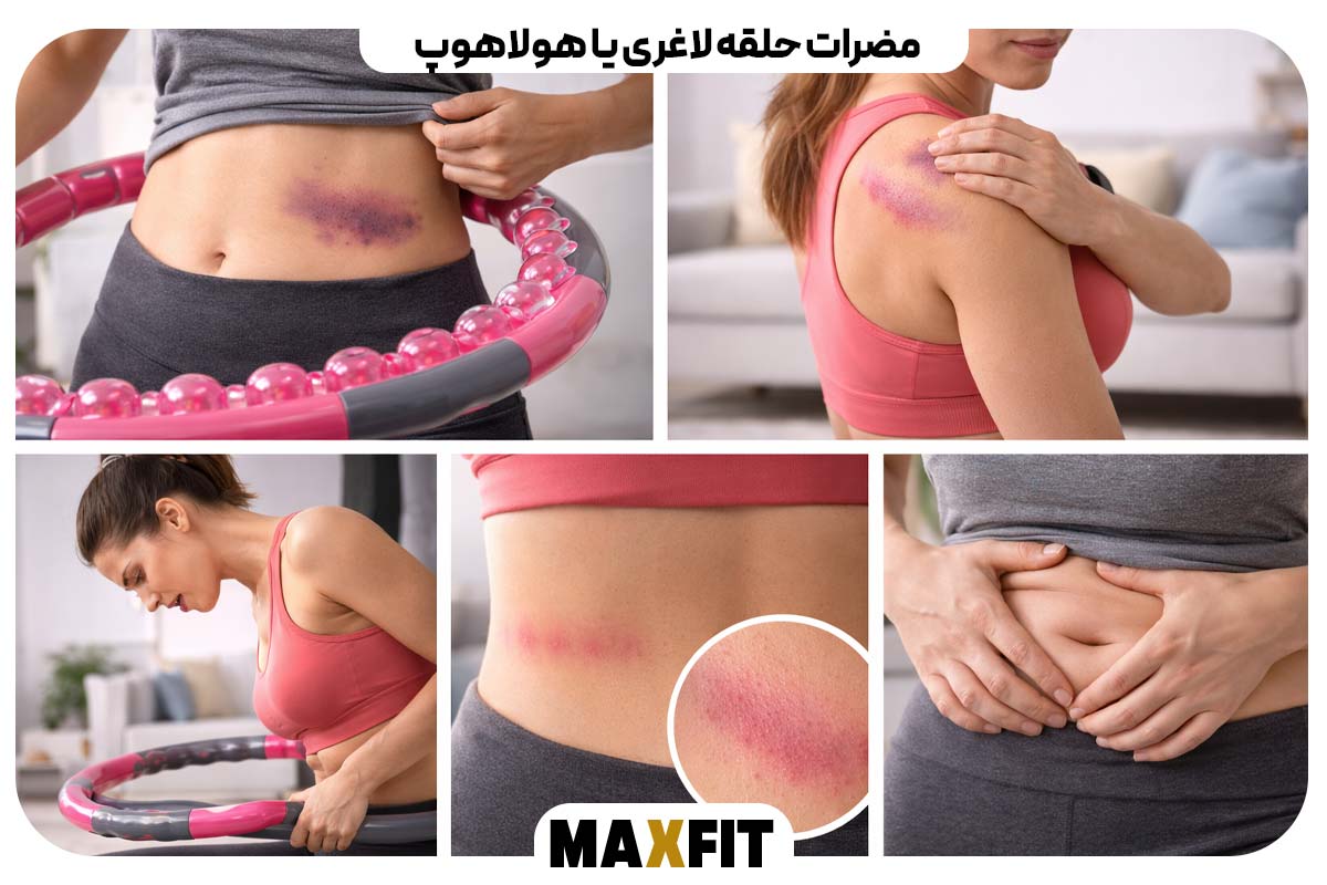 مضرات حلقه لاغری یا هولاهوپ