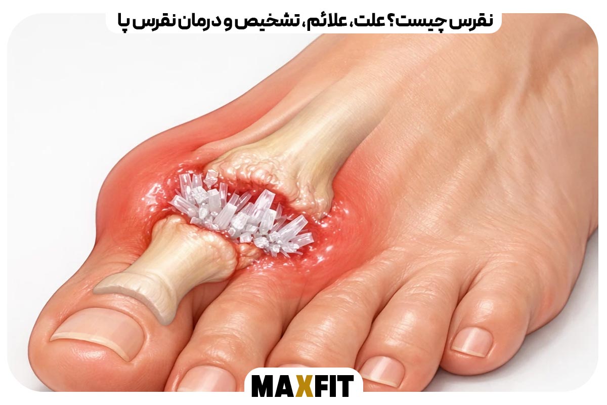 نقرس چیست؟ علت، علائم، تشخیص و درمان نقرس پا